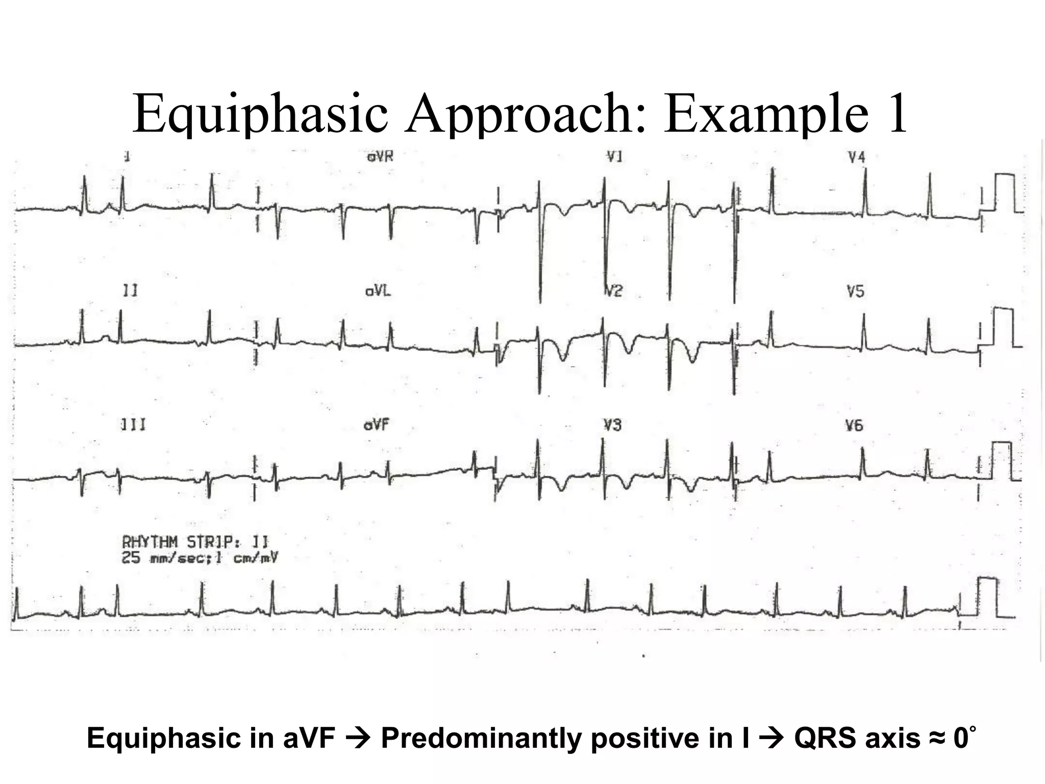 Equiphasic Approach: Example 1
Equiphasic in aVF  Predominantly positive in I  QRS axis ≈ 0°
 