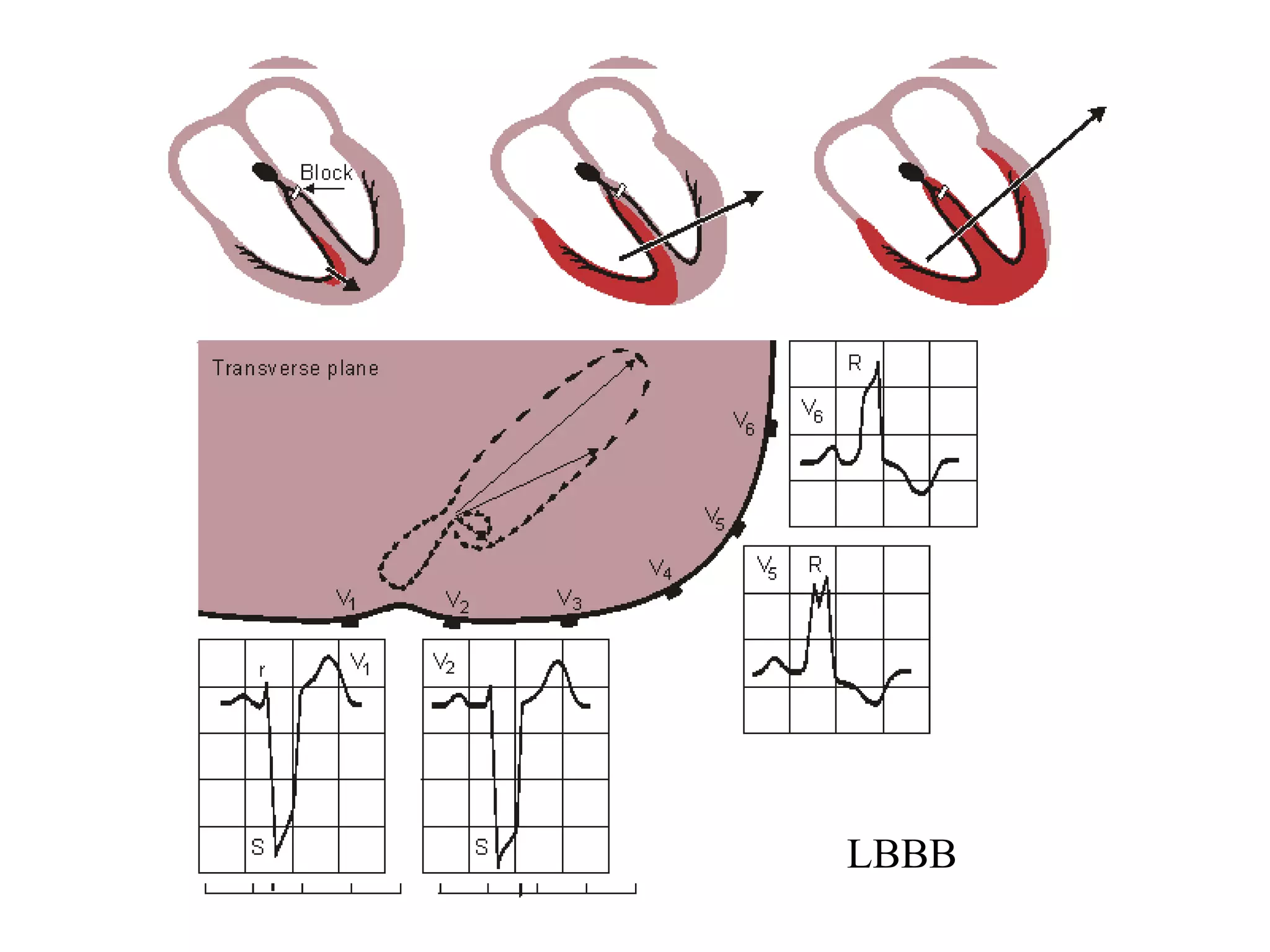 LBBB
 