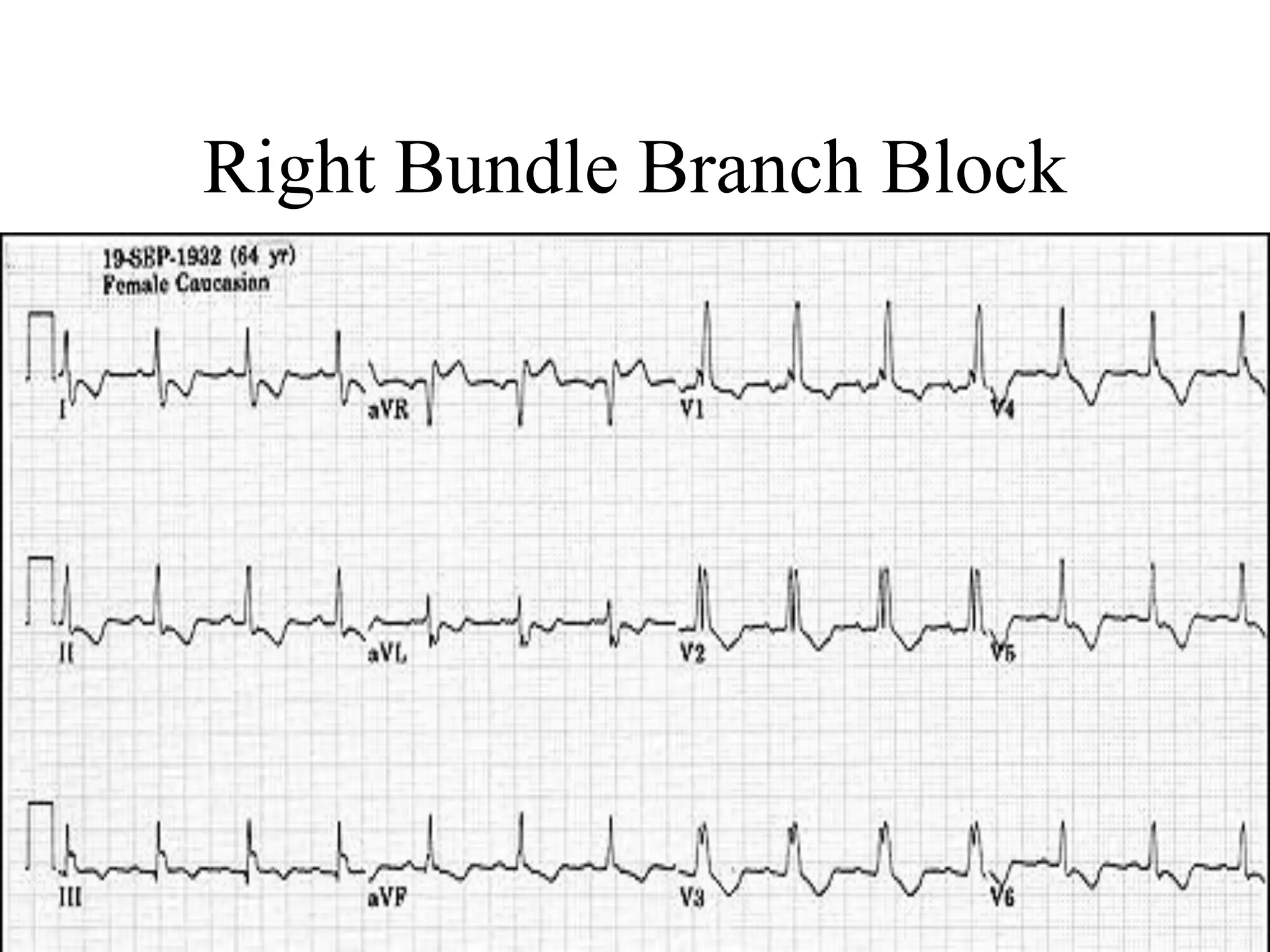 Right Bundle Branch Block
 