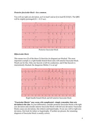 4
Posterior fascicular block - less common.
You will see right axis deviation, an S in lead I and an Q in lead III (S1Q3). The QRS
will be slightly prolonged (0.1 - 0.12 sec).
Posterior fascicular block
Bifascicular block.
This means two (2) of the three (3) fascicles (in diagram) are blocked. The most
important example is a right bundle branch block and a left anterior fascicular block.
Watch out for this. Only one fascicle is left for conduction, and if that fascicle is
intermittently blocked, the dangerous Mobitz 2 is set up!
Right bundle branch block and left anterior fascicular block
"Fascicular Blocks" may seem a bit complicated - simply remember that axis
deviation is the clue. In your differential, consider posterior fascicular blocks with right
axis deviation and consider anterior fascicular blocks with left axis deviation. Fascicular
blocks cause axis deviations, like infarcts and hypertrophy. If you see a left or right axis
deviation, first look for infarct or hypertrophy. If neither are present, the remaining
diagnosis of fascicular block is usually correct.
 