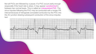 ECG Rhythm Abnormalities | PPTX