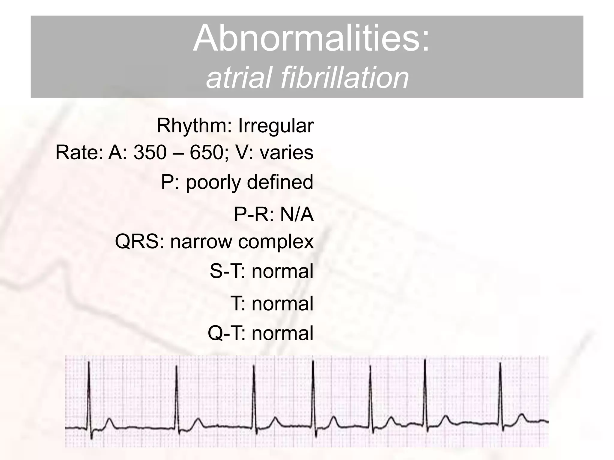 Abnormalities:
atrial fibrillation
Rhythm: Irregular
Rate: A: 350 – 650; V: varies
P: poorly defined
P-R: N/A
QRS: narrow complex
S-T: normal
T: normal
Q-T: normal
 