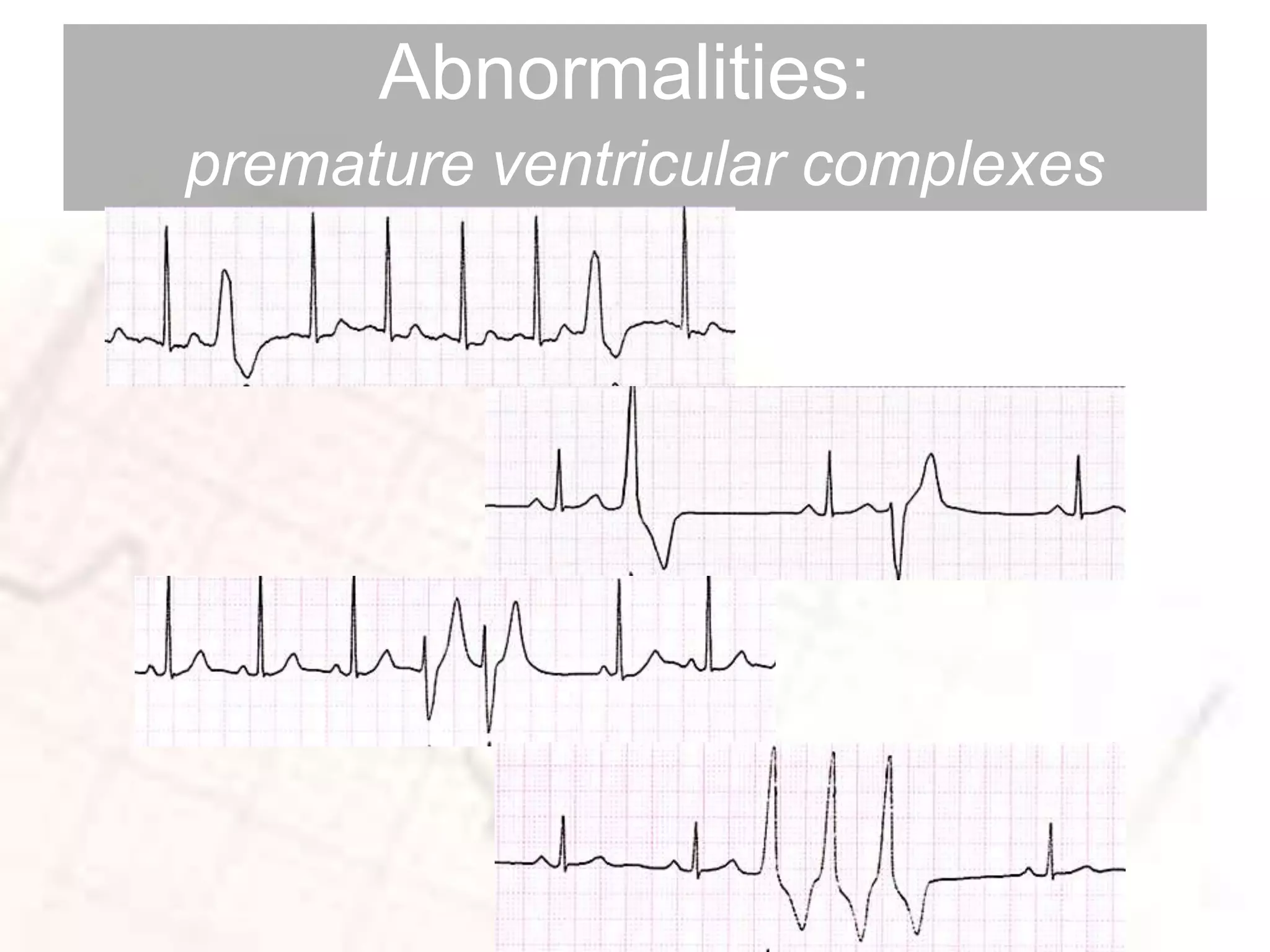 Abnormalities:
premature ventricular complexes
 