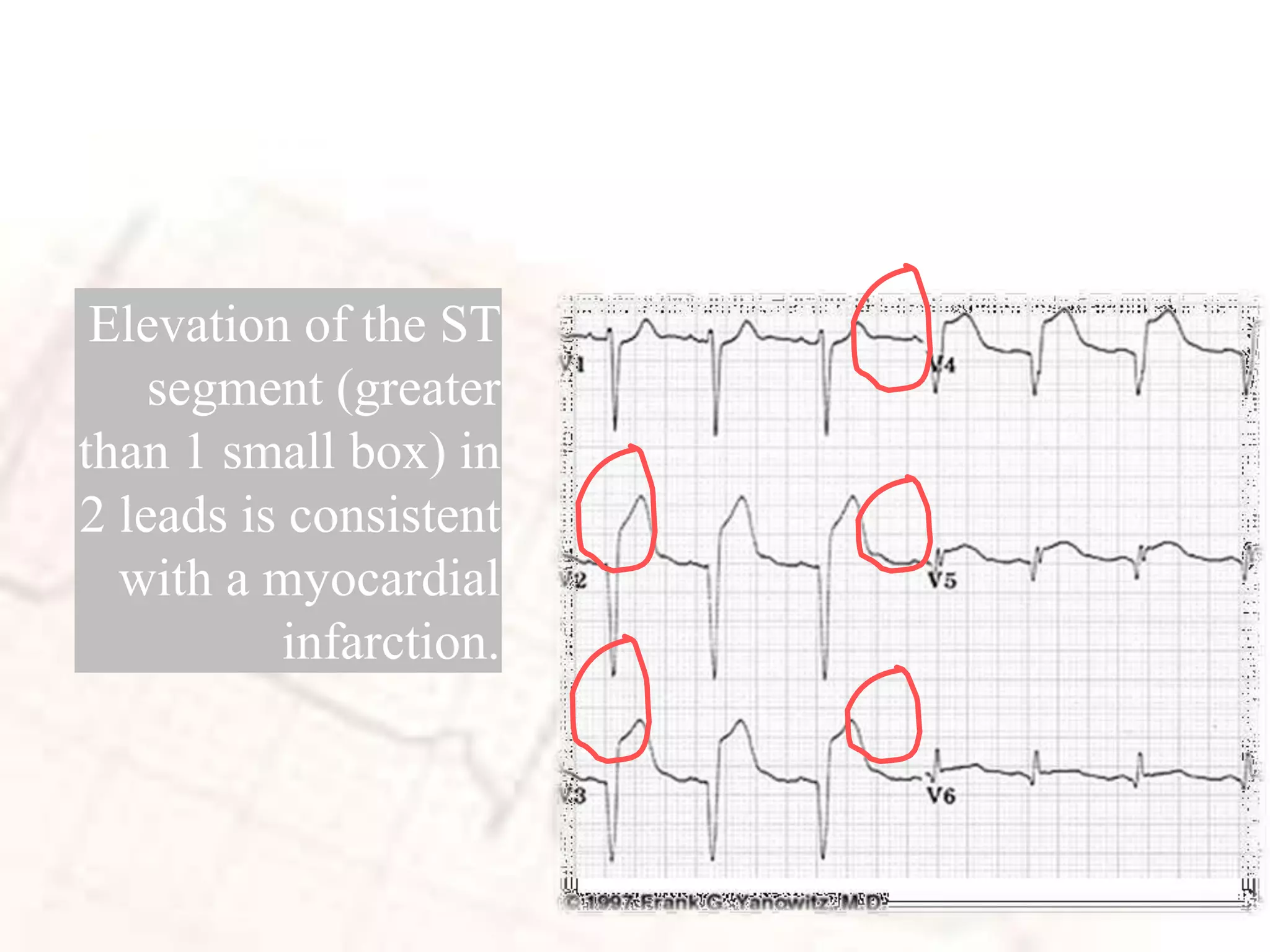 ST Elevation (cont)
Elevation of the ST
segment (greater
than 1 small box) in
2 leads is consistent
with a myocardial
infarction.
 