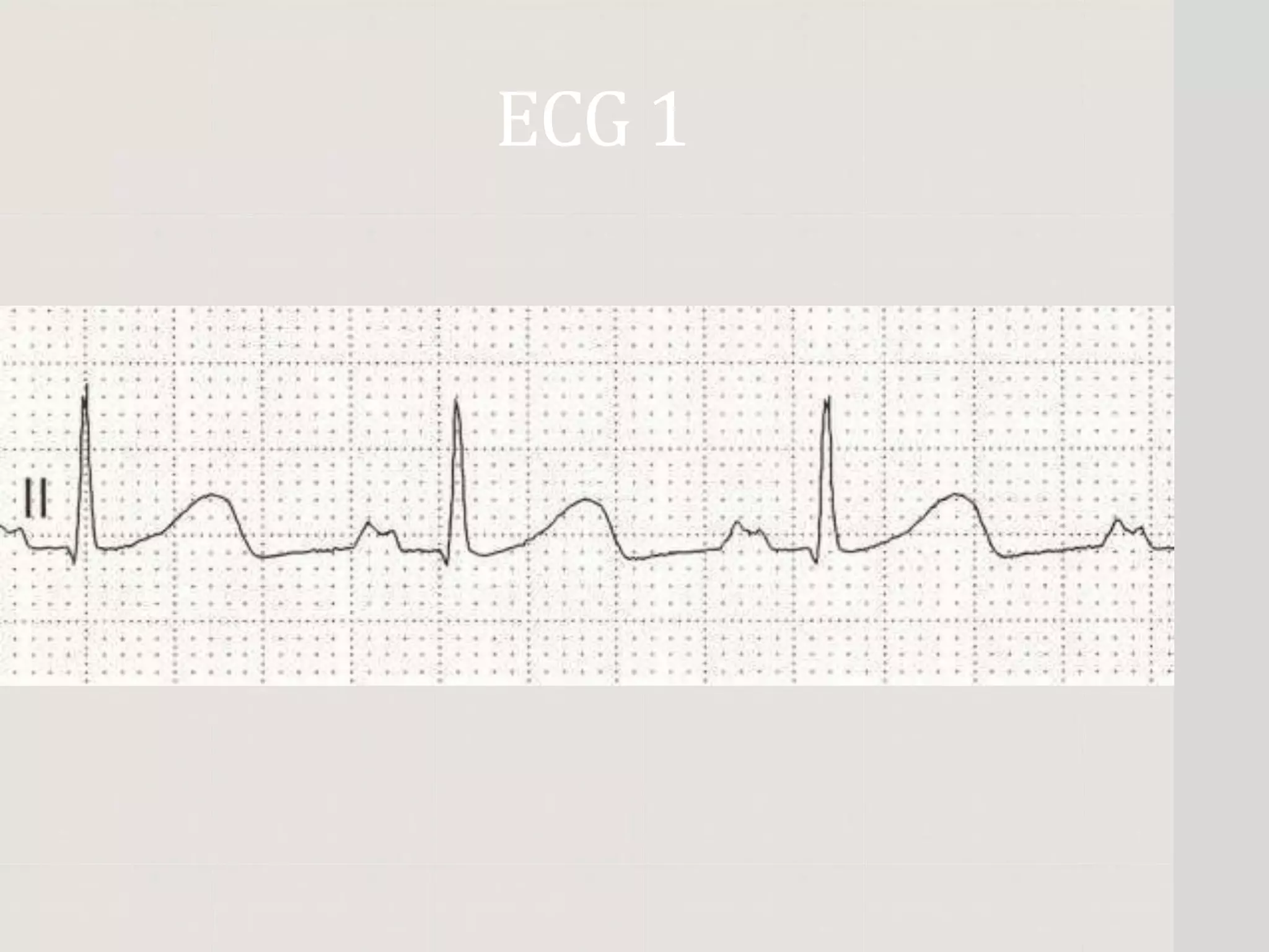 ECG 1
 