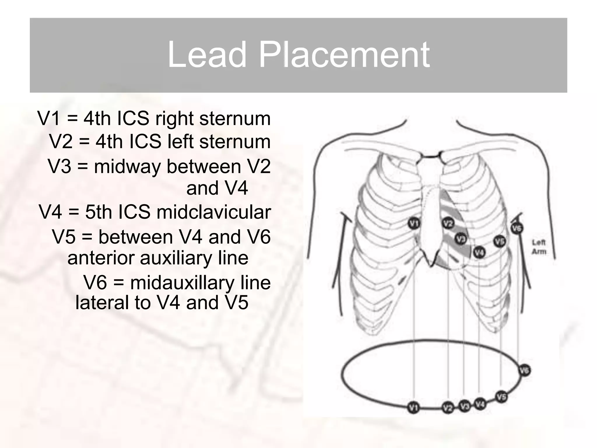 Lead Placement
V1 = 4th ICS right sternum
V2 = 4th ICS left sternum
V3 = midway between V2
and V4
V4 = 5th ICS midclavicular
V5 = between V4 and V6
anterior auxiliary line
V6 = midauxillary line
lateral to V4 and V5
 