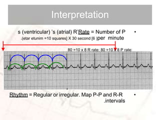 basic ECG SAMPLE WAY | PPTX