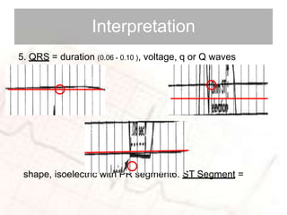basic ECG SAMPLE WAY | PPTX