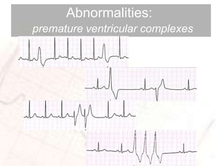 basic ECG SAMPLE WAY | PPTX