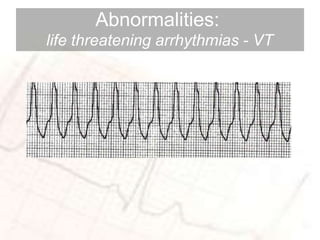 basic ECG SAMPLE WAY | PPTX