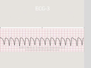 basic ECG SAMPLE WAY | PPTX
