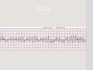 basic ECG SAMPLE WAY | PPTX