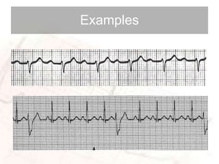 basic ECG SAMPLE WAY | PPTX