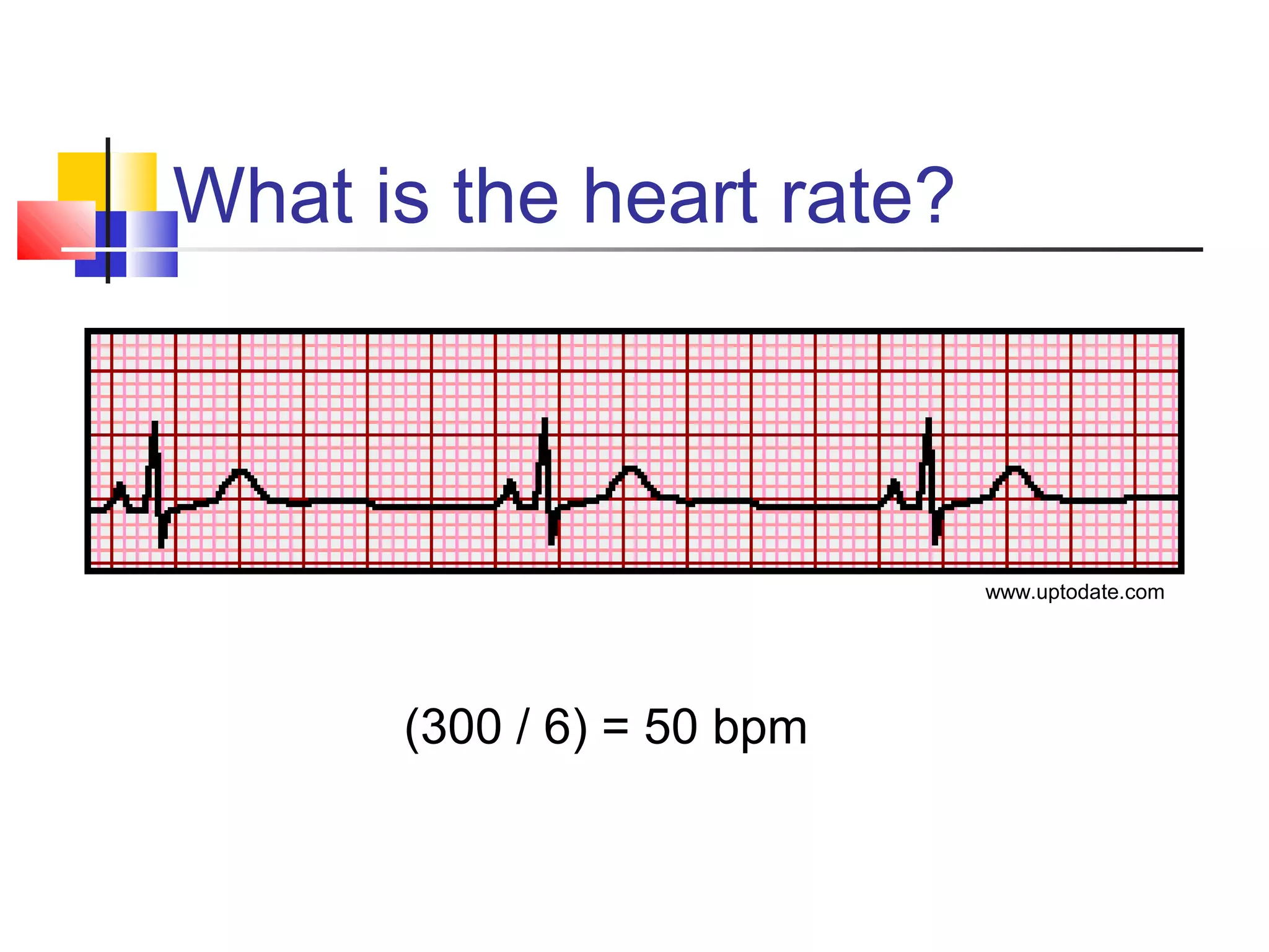 What is the heart rate?
(300 / 6) = 50 bpm
www.uptodate.com
 
