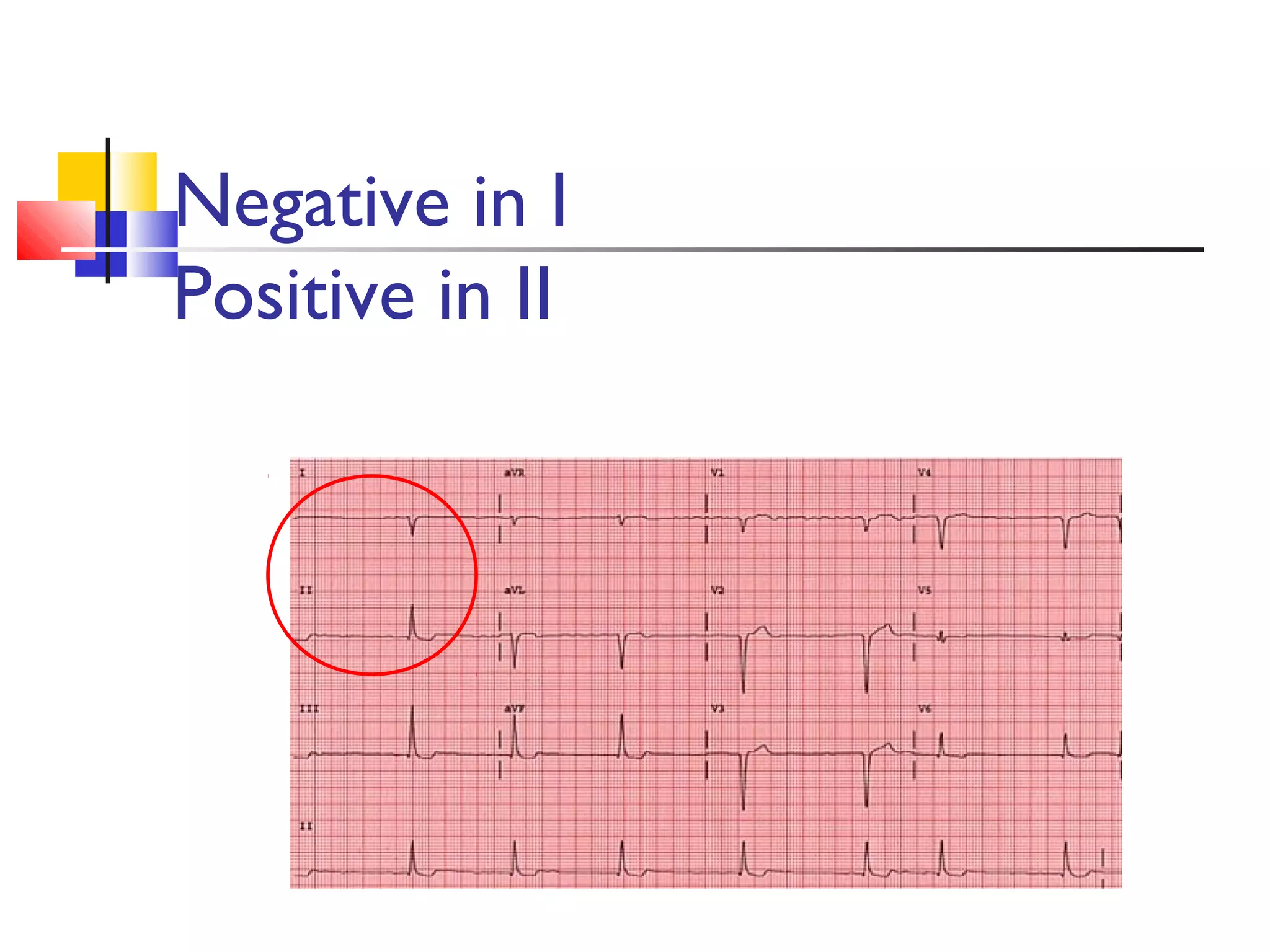 Negative in I
Positive in II
 