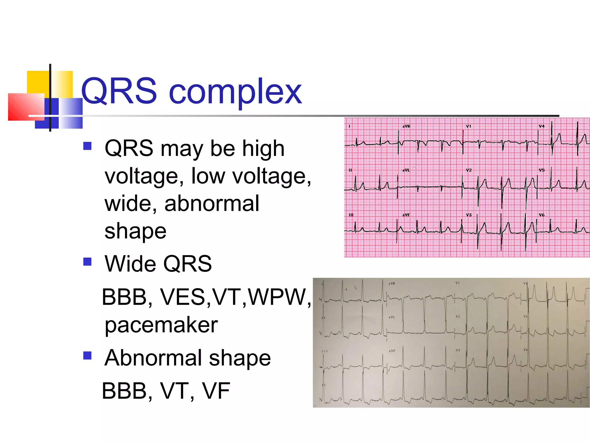 QRS complex
 QRS may be high
voltage, low voltage,
wide, abnormal
shape
 Wide QRS
BBB, VES,VT,WPW,
pacemaker
 Abnormal shape
BBB, VT, VF
 