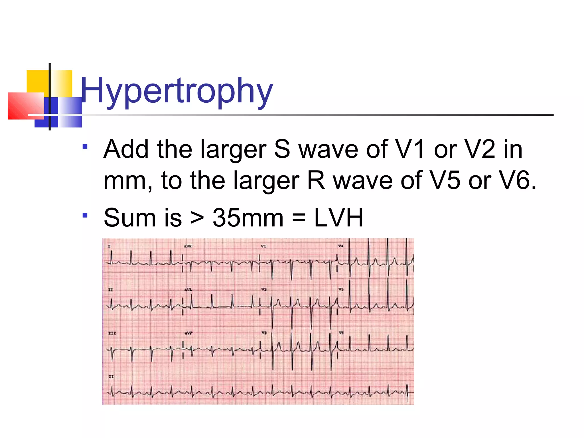 Hypertrophy
 Add the larger S wave of V1 or V2 in
mm, to the larger R wave of V5 or V6.
 Sum is > 35mm = LVH
 