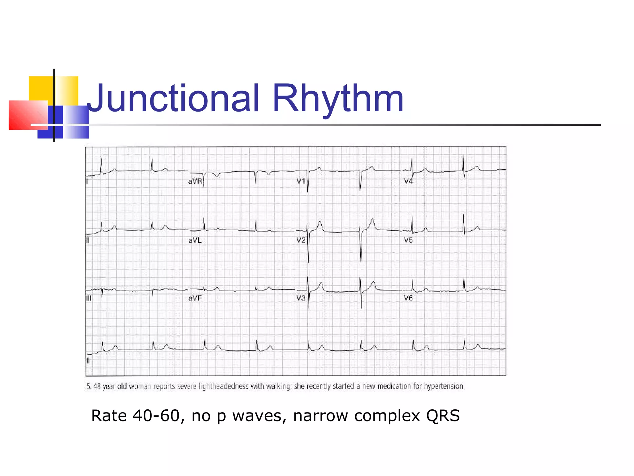 Junctional Rhythm
Rate 40-60, no p waves, narrow complex QRS
 
