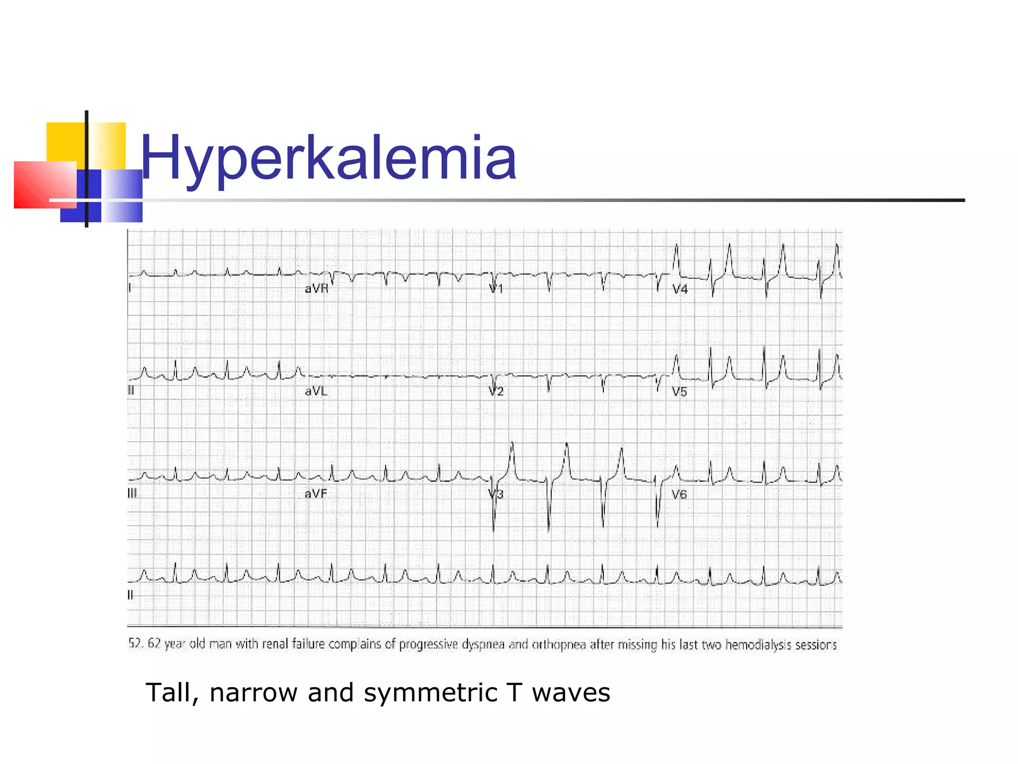 Hyperkalemia
Tall, narrow and symmetric T waves
 