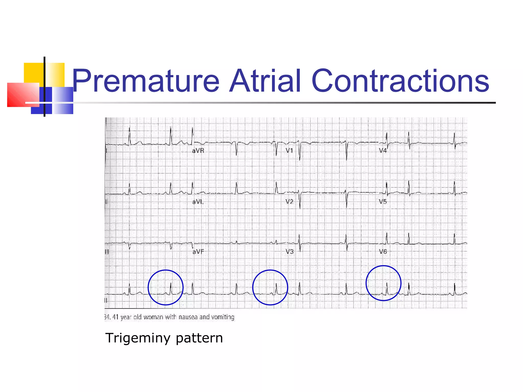 Premature Atrial Contractions
Trigeminy pattern
 