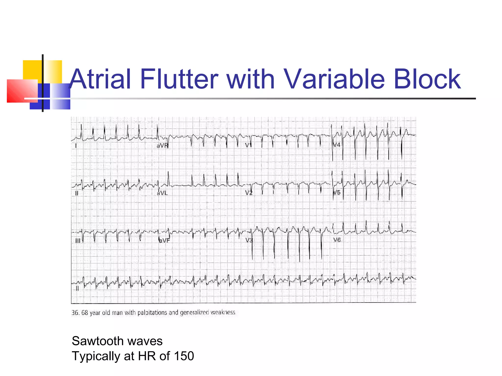 Atrial Flutter with Variable Block
Sawtooth waves
Typically at HR of 150
 