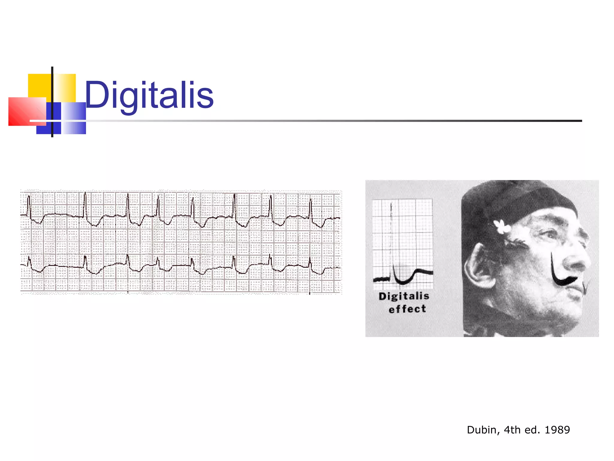 Digitalis
Dubin, 4th ed. 1989
 