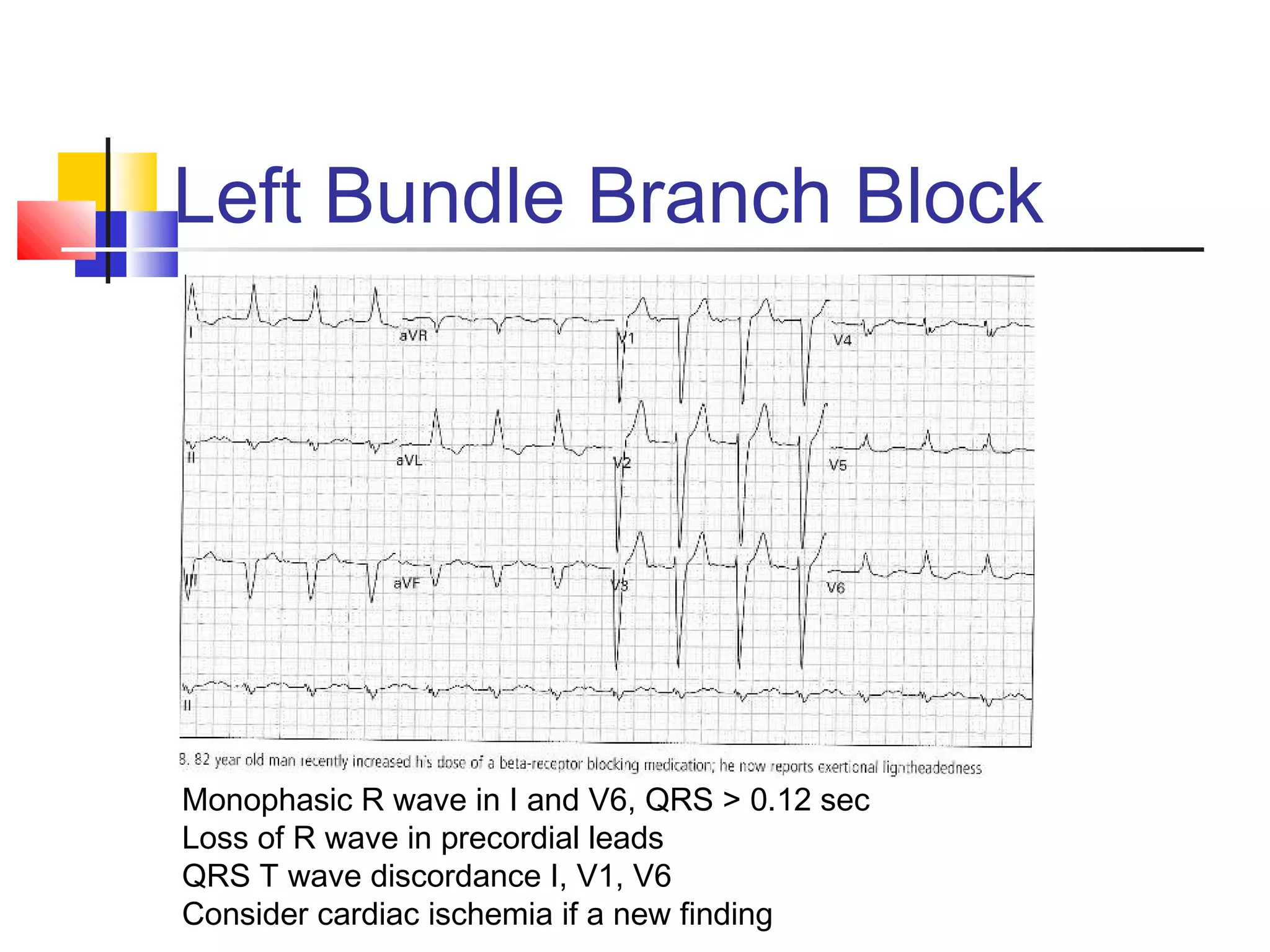 Left Bundle Branch Block
Monophasic R wave in I and V6, QRS > 0.12 sec
Loss of R wave in precordial leads
QRS T wave discordance I, V1, V6
Consider cardiac ischemia if a new finding
 