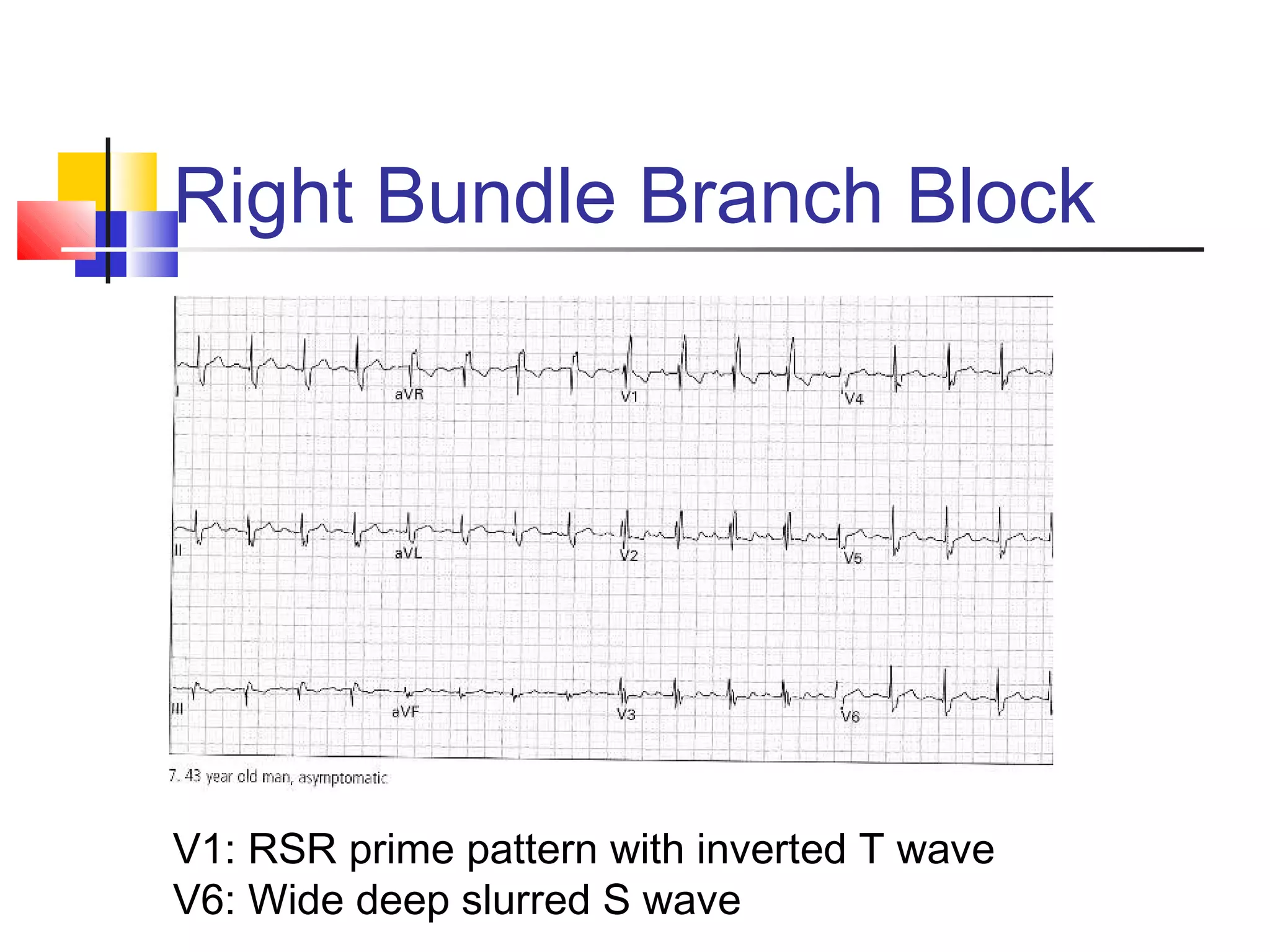 Right Bundle Branch Block
V1: RSR prime pattern with inverted T wave
V6: Wide deep slurred S wave
 