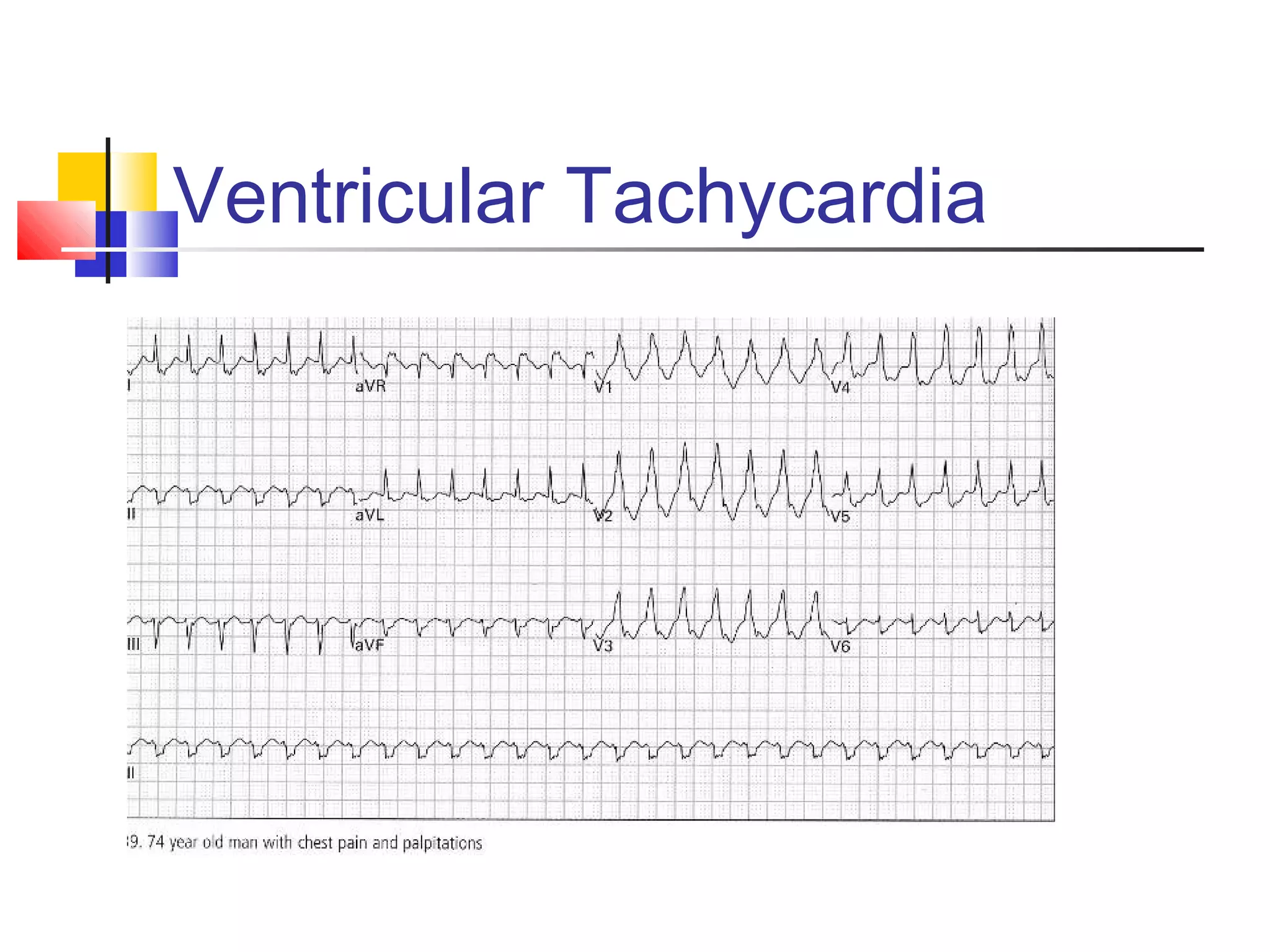 Ventricular Tachycardia
 