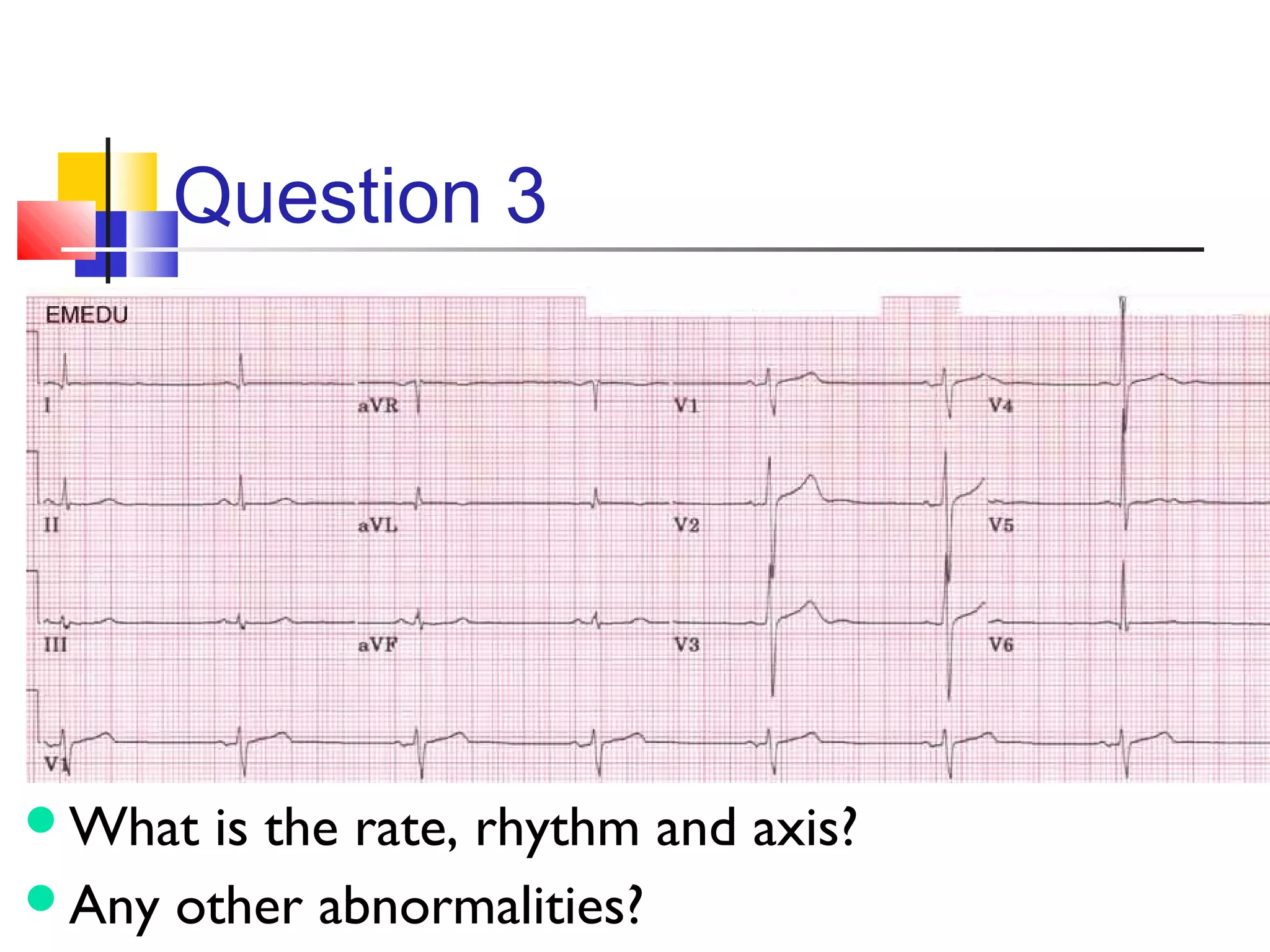 Question 3
What is the rate, rhythm and axis?
Any other abnormalities?
 