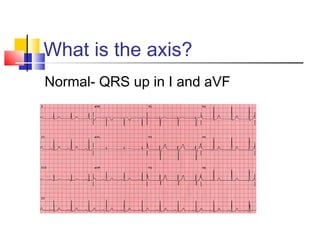 ECG Interpretation | PPT