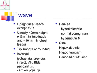 ECG Interpretation | PPT