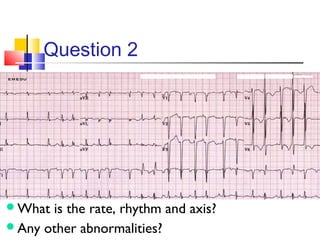 ECG Interpretation | PPT