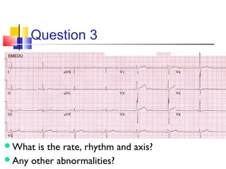 ECG Interpretation | PPT