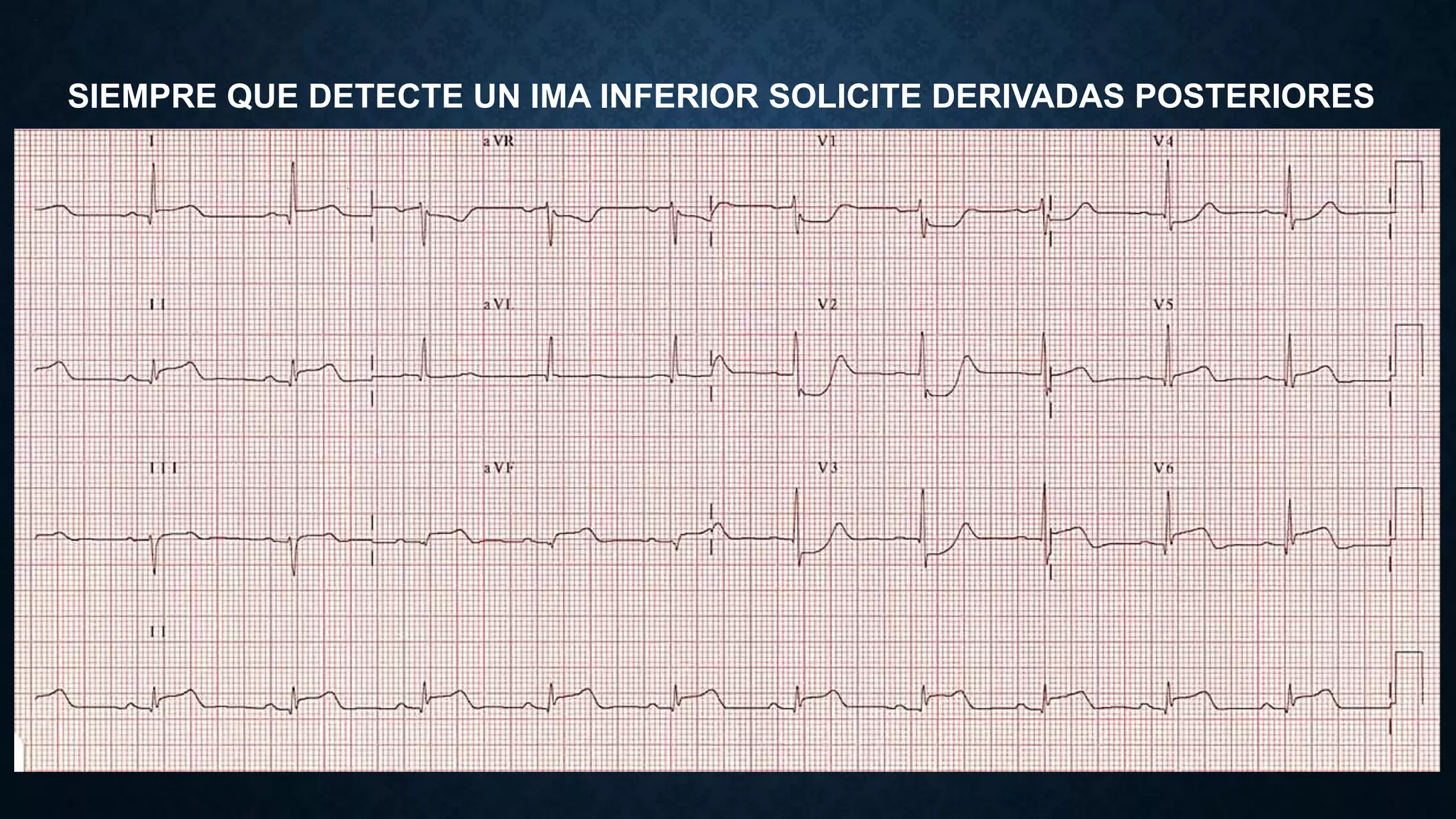 ECG EN INFARTO AGUDO DE MIOCARDIO URP 2022.pptx | Heart and ...