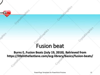 Fusion beat
Burns E. Fusion Beats (July 19, 2018). Retrieved from
https://lifeinthefastlane.com/ecg-library/basics/fusion-beats/
PowerPlugs Templates for PowerPoint Preview 11
 