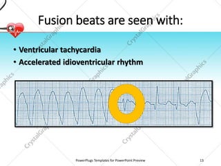 Fusion beats are seen with:
• Ventricular tachycardia
• Accelerated idioventricular rhythm
PowerPlugs Templates for PowerPoint Preview 13
 