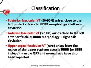 Classification
• Posterior fascicular VT (90-95%) arises close to the
left posterior fascicle: RBBB morphology + left axis
deviation.
• Anterior fascicular VT (5-10%) arises close to the left
anterior fascicle: RBBB morphology + right axis
deviation.
• Upper septal fascicular VT (rare) arises from the
region of the upper septum: usually RBBB (or LBBB
instead), narrow QRS and normal axis have also
been reported.
PowerPlugs Templates for PowerPoint Preview 6
 