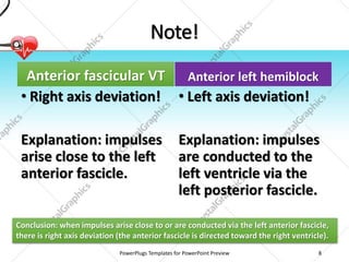 Note!
Anterior fascicular VT
• Right axis deviation!
Explanation: impulses
arise close to the left
anterior fascicle.
Anterior left hemiblock
• Left axis deviation!
Explanation: impulses
are conducted to the
left ventricle via the
left posterior fascicle.
PowerPlugs Templates for PowerPoint Preview 8
Conclusion: when impulses arise close to or are conducted via the left anterior fascicle,
there is right axis deviation (the anterior fascicle is directed toward the right ventricle).
 