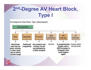 2nd-Degree AV Heart Block,
Type I
 