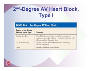 2nd-Degree AV Heart Block,
Type I
 
