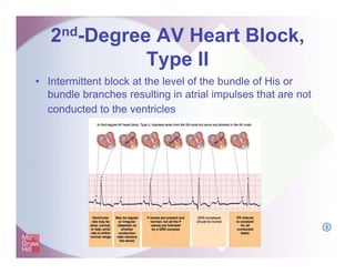 2nd-Degree AV Heart Block,
Type II
• Intermittent block at the level of the bundle of His or
bundle branches resulting in atrial impulses that are not
conducted to the ventricles
I
 