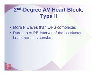 2nd-Degree AV Heart Block,
Type II
• More P waves than QRS complexes
• Duration of PR interval of the conducted
beats remains constant
 