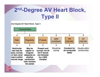 2nd-Degree AV Heart Block,
Type II
 
