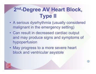 2nd-Degree AV Heart Block,
Type II
• A serious dysrhythmia (usually considered
malignant in the emergency setting)
• Can result in decreased cardiac output
and may produce signs and symptoms of
hypoperfusion
• May progress to a more severe heart
block and ventricular asystole
I
 