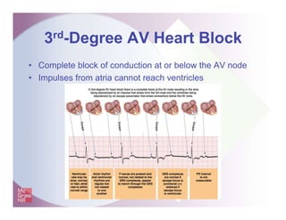 3rd-Degree AV Heart Block
• Complete block of conduction at or below the AV node
• Impulses from atria cannot reach ventricles
 