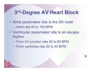 3rd-Degree AV Heart Block
• Atrial pacemaker site is the SA node
– Atrial rate 60 to 100 BPM
• Ventricular pacemaker site is an escape
rhythm
– From AV junction rate 40 to 60 BPM
– From ventricles rate 20 to 40 BPM
Q
 