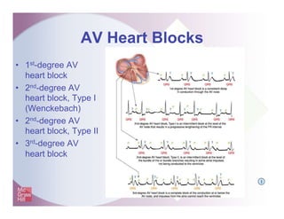 AV Heart Blocks
• 1st-degree AV
heart block
• 2nd-degree AV
heart block, Type I
(Wenckebach)
• 2nd-degree AV
heart block, Type II
• 3rd-degree AV
heart block
I
 