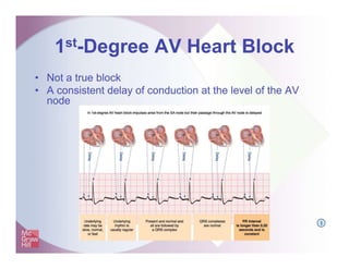 1st-Degree AV Heart Block
• Not a true block
• A consistent delay of conduction at the level of the AV
node
I
 