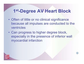 1st-Degree AV Heart Block
• Often of little or no clinical significance
because all impulses are conducted to the
ventricles
• Can progress to higher degree block,
especially in the presence of inferior wall
myocardial infarction
I
 